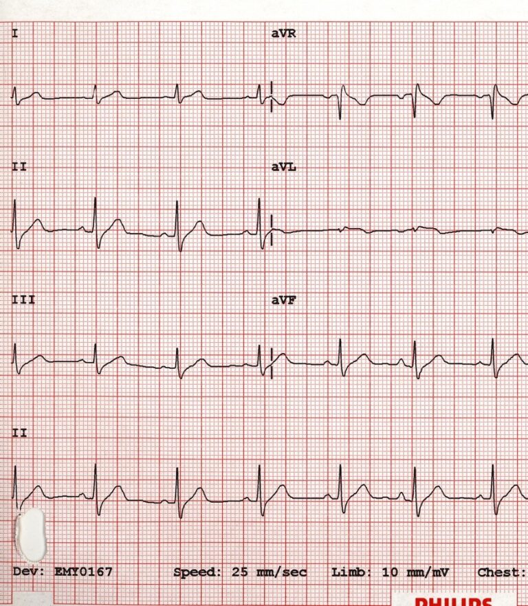 ecg1