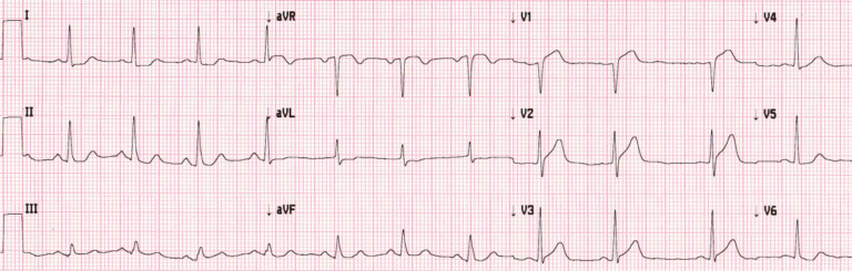 1164-ECG-01