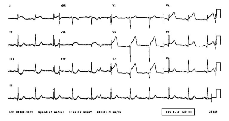 ecg1